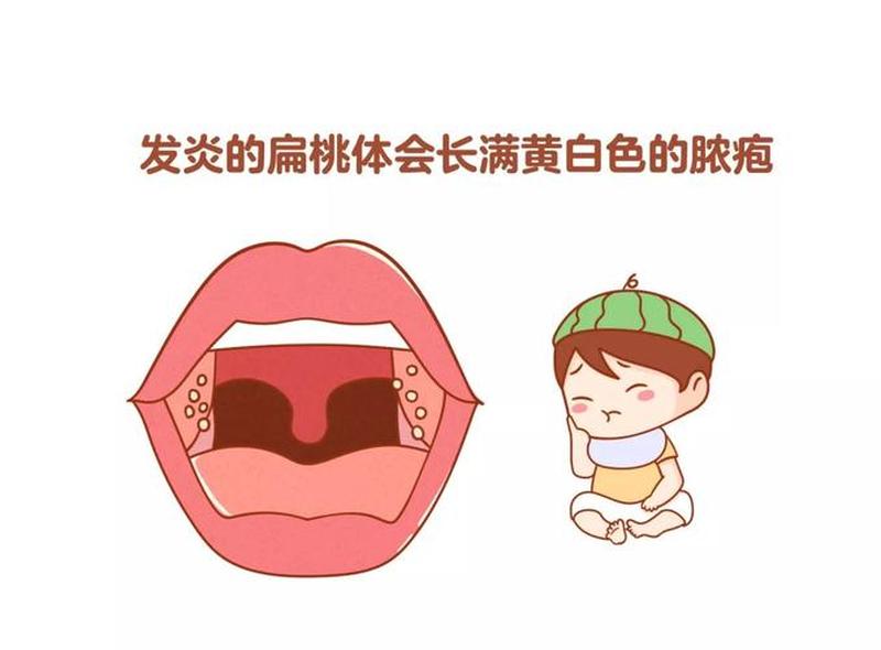 扁桃体发炎 扁桃体发炎