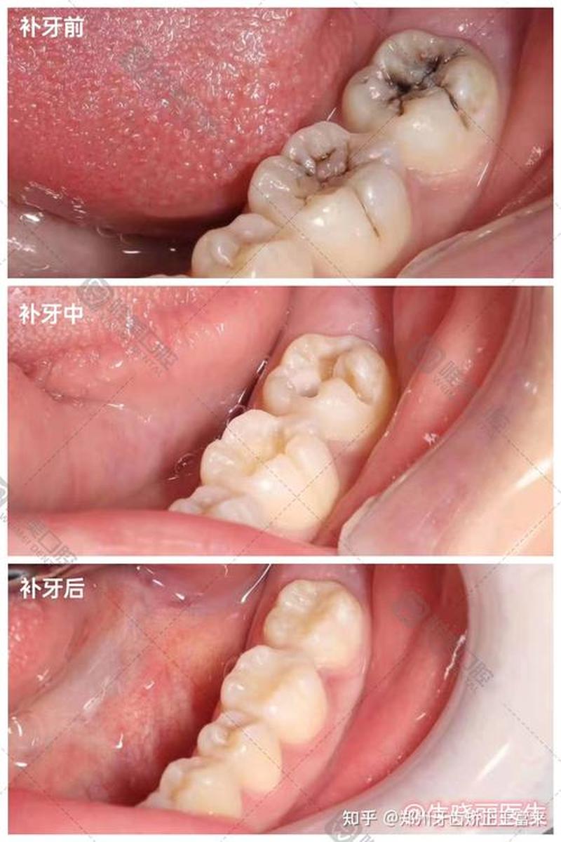 补牙 补牙