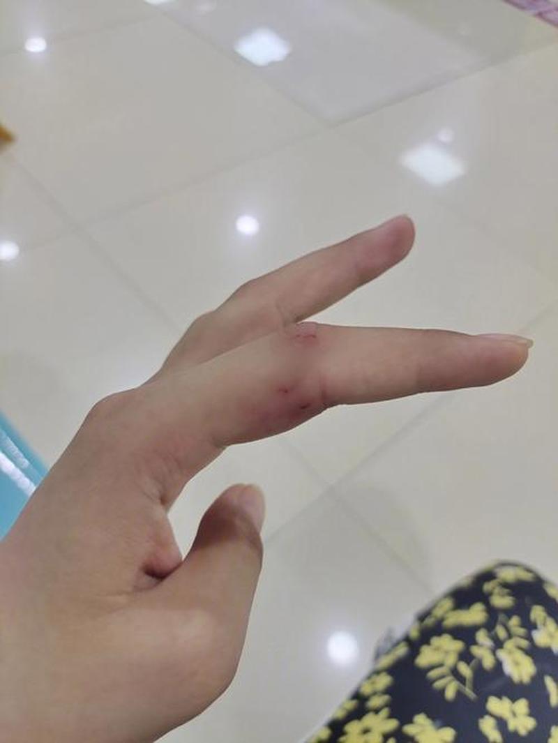 手肿 手肿